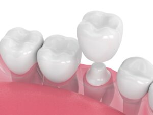 dental crown 3D illustration 