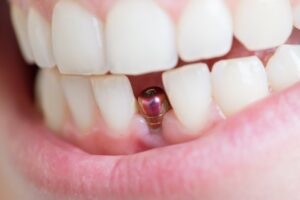 Closeup of patient after dental implant surgery in Richardson