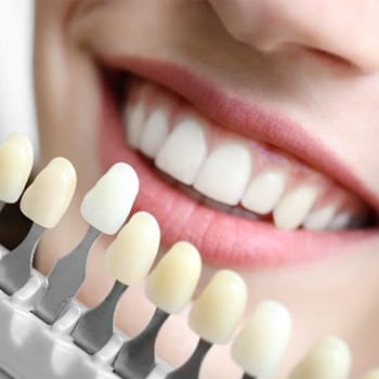 Veneer Color matching to a woman's teeth - Cosmetic Dentistry in Dallas TX