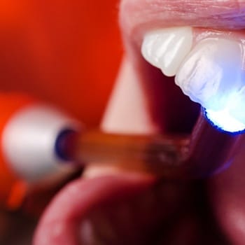 Curing light used to cure dental bonding in Dallas TX