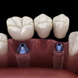 An illustration of dental implants and a bridge.