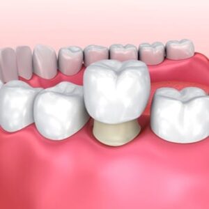A graphic image of a dental crown being placed over a tooth.