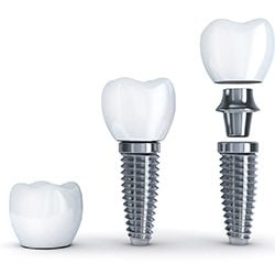 3 dental implants next to each other