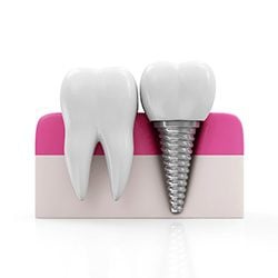 Picture of a tooth next to a Dental Implant