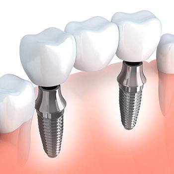 3d image of dental implants in Dallas TX