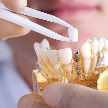 Dentist showing implant technology on 3d model of teeth - Restorative Dentistry in Dallas, TX