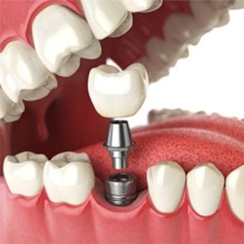 Dental implant being placed in mouth