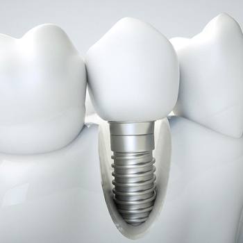 3d image of a dental implant in Dallas TX