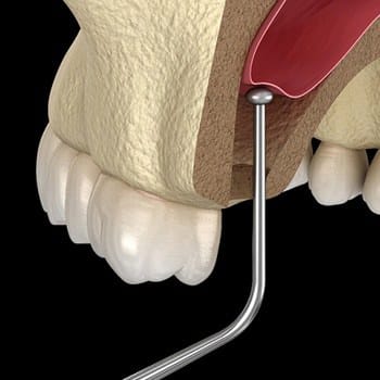 3d model of a dental implant procedure in Dallas TX