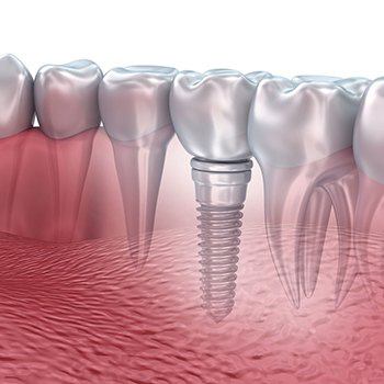 3d visual of a dental implant in Dallas TX