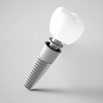 Dental Implant in Dallas Texas