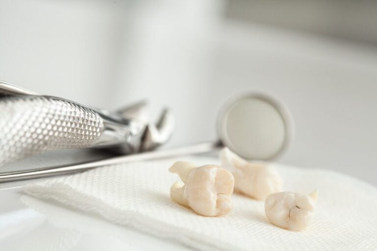 Tooth Extractions in Dallas, TX