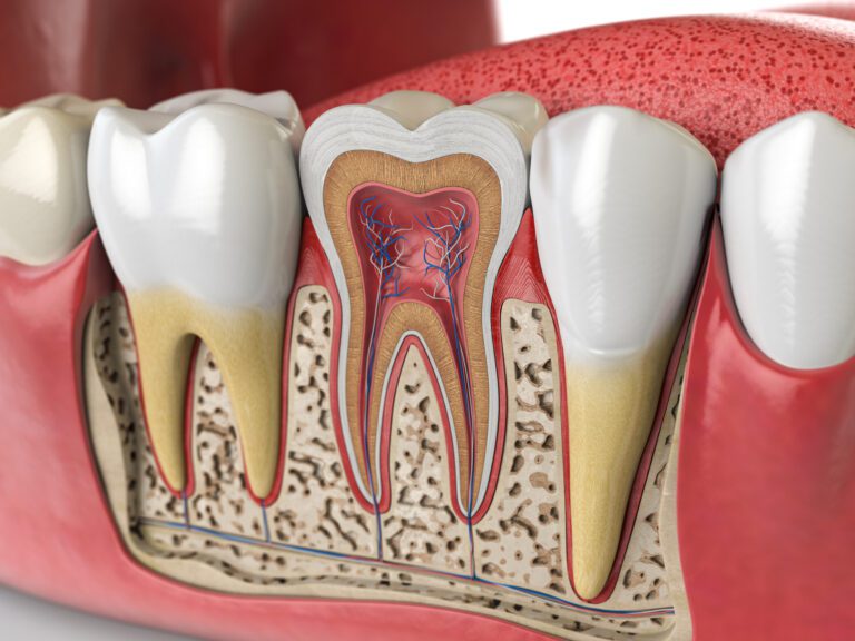 Tooth infection in need of a root canal