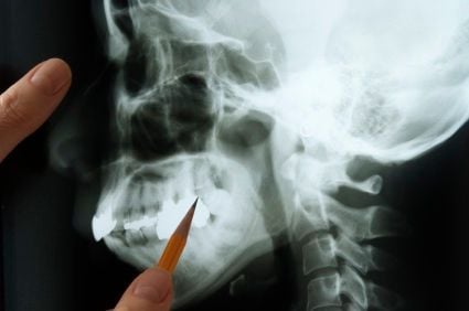 An image of a jawbone being pointed to with a pencil.