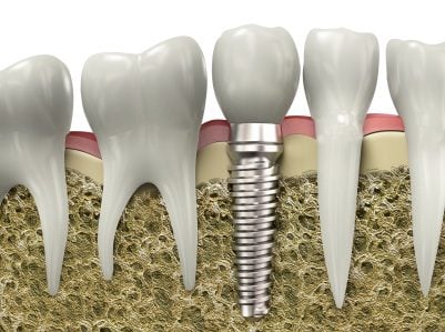 A graphic image of a Dallas area dental implant.